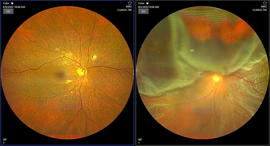 Retinal and Vitreous